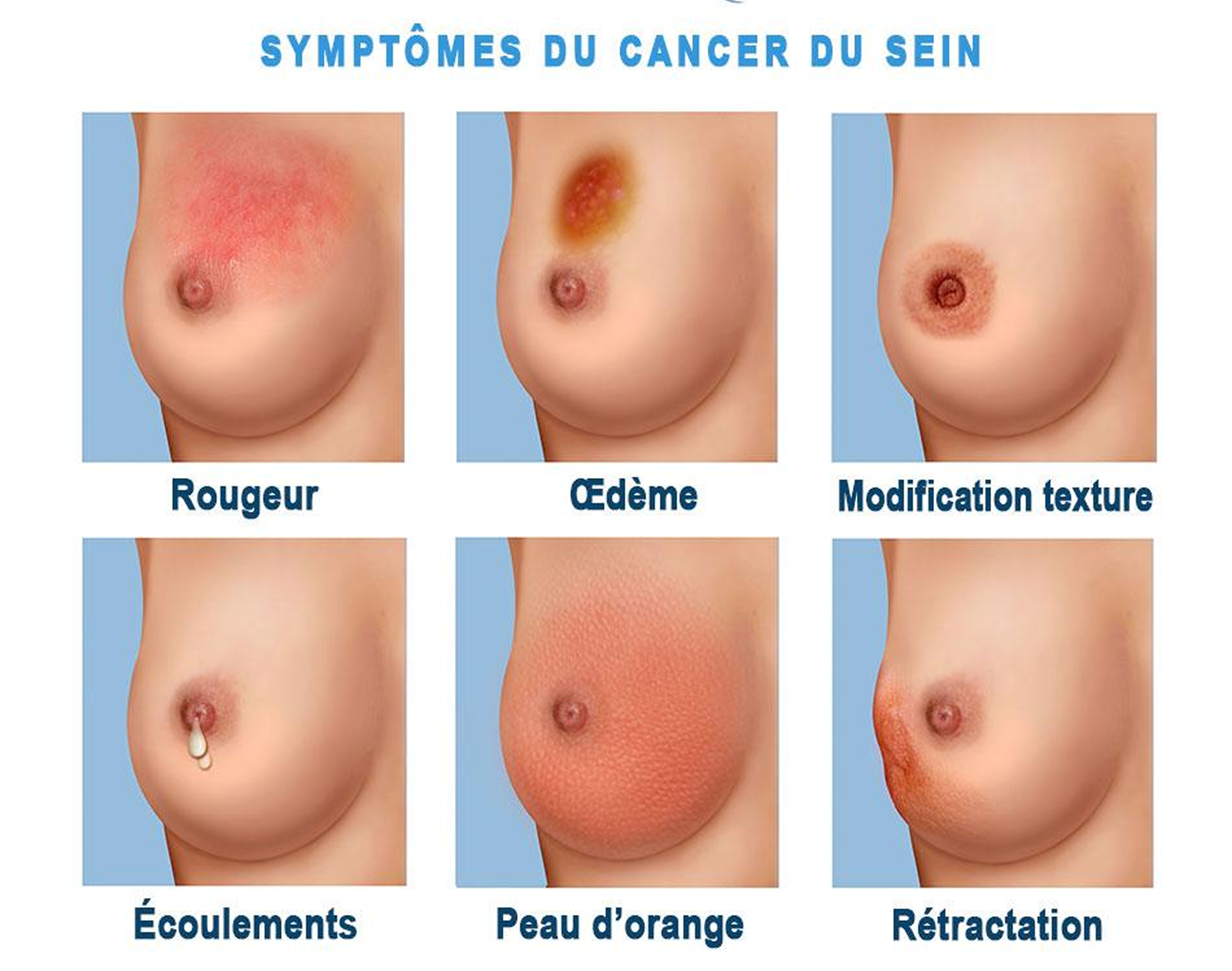 breast cancer symptom diagram 